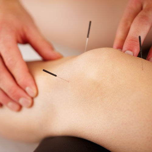 square-one_muscular-acupuncture